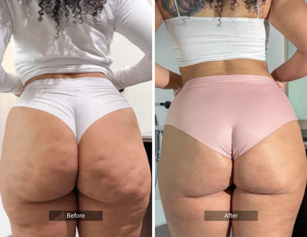 CELLULITE